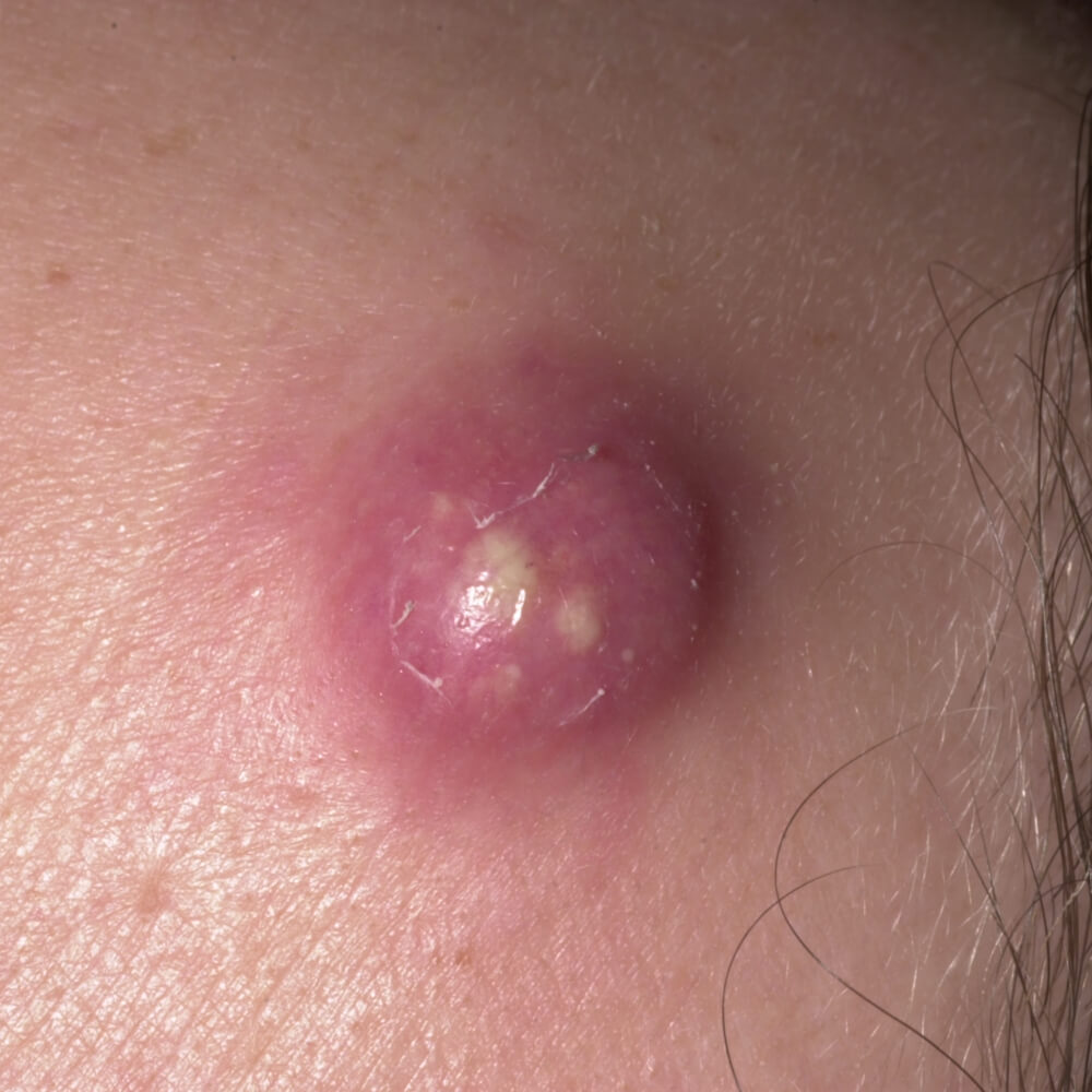 Other considerations, for example, epidermoid or dermoid cyst, pilonidal cyst, erysipelas