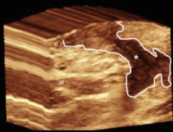3D ultrasound hidradenitis suppurativa image demonstrates a sinus tract that affects the dermis and subcutaneous tissue