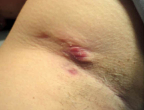 Clinical image of a hidradenitis suppurativa underarm case classified as Hurley stage II