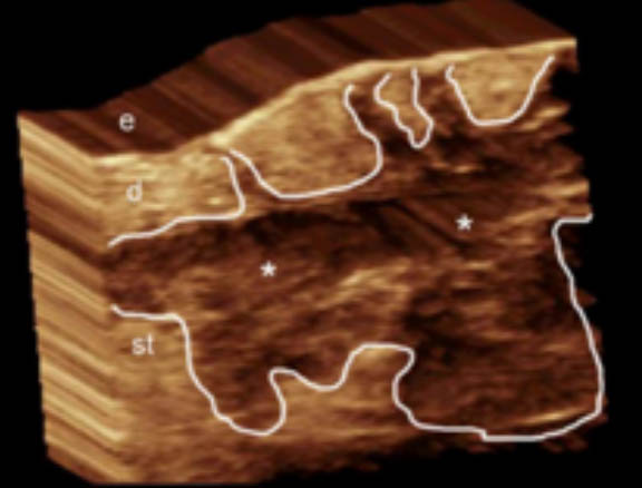3D ultrasound hidradenitis suppurativa image demonstrates a hypoechoic fluid collection with echoes (debris) in the subcutaneous tissue and dermis, also connected to the base of the hair follicles