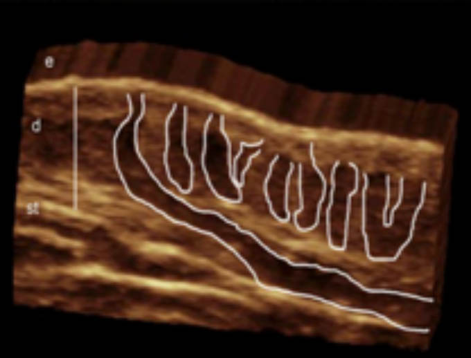 3D ultrasound hidradenitis suppurativa image show involvement of multiple hair follicles