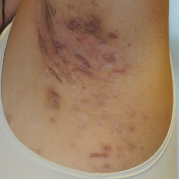 Hidradenitis suppurativa (HS) Hurley Stage II in the axilla region