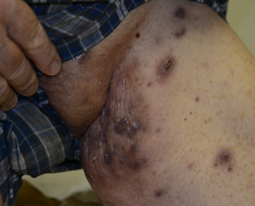 Hidradenitis suppurativa (HS) lesions on a patient's leg