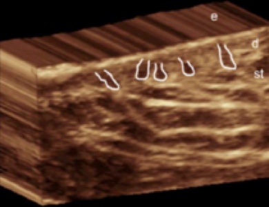 3D ultrasound hidradenitis suppurativa image demonstrates predominant enlargement of the base of the hair follicles in the deep portion of the dermis